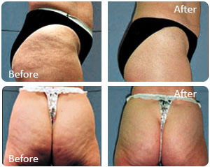 anti-cellulite